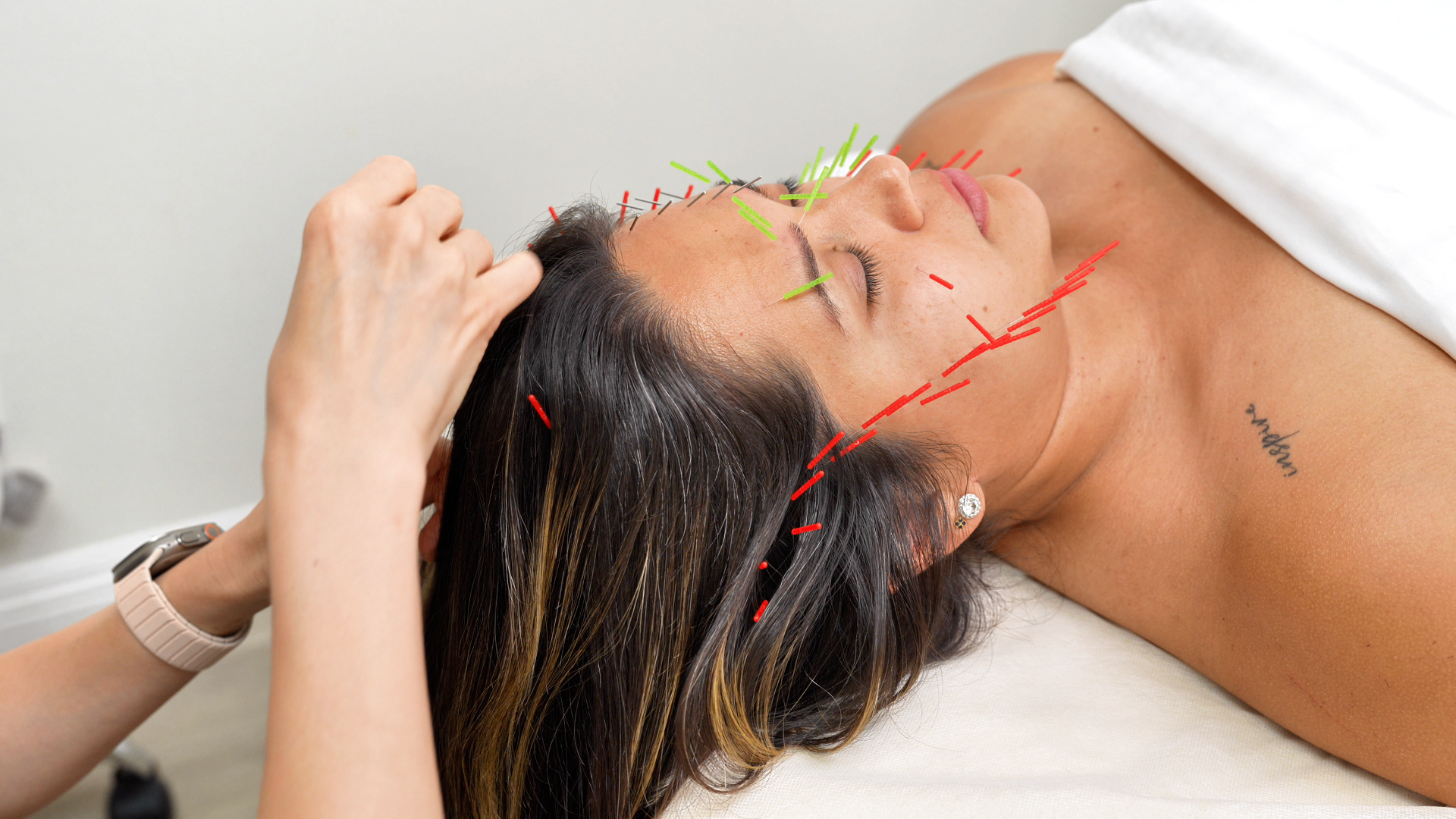Dr. Lydia performing the Meridian Lift Method™ with color-coded needle placements on a patient